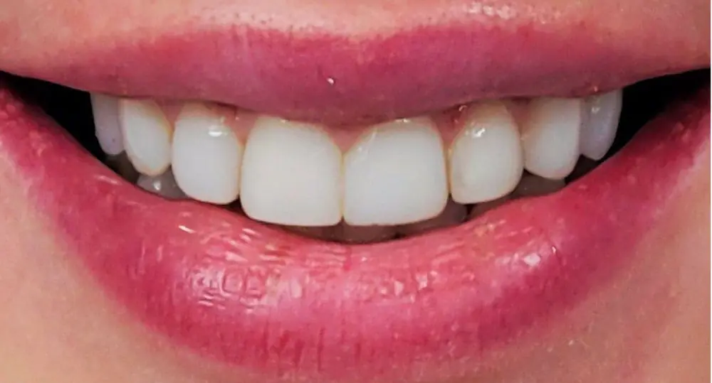 Pirms ārstēšanas